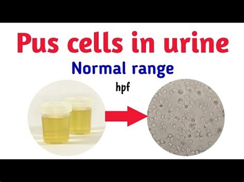 pus cells in urine normal value